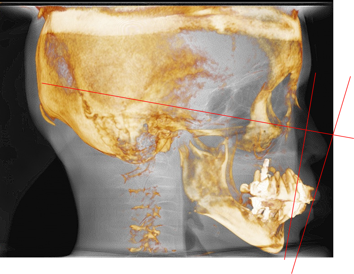 歯科用CT